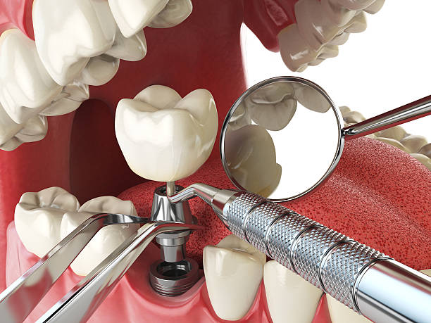 Best Emergency Dental Extractions in Redland, MD